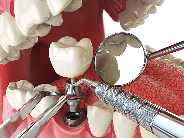 Best Emergency Tooth Extraction in Richton Park, IL